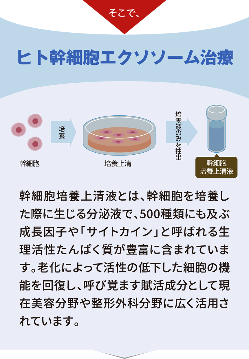 そこでヒト幹細胞エクソソーム治療。幹細胞培養上清液とは、幹細胞を培養した際に生じる分泌液で、500種類にも及ぶ成長因子や「サイトカイン」と呼ばれる生理活性たんぱく質が豊富に含まれています。老化によって活性の低下した細胞の機能を回復し、呼び覚ます賦活成分として現在美容分野や整形外科分野に広く活用されています。